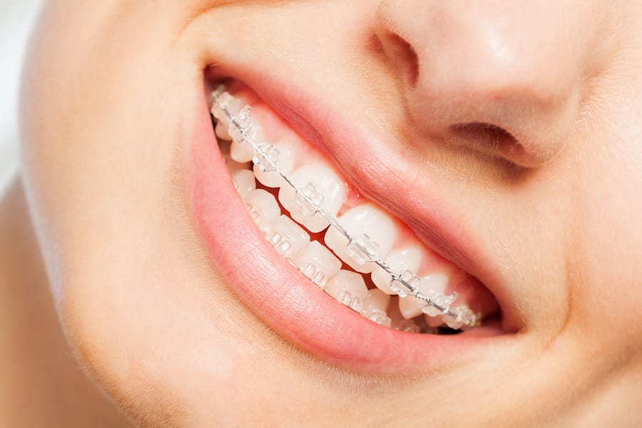 Ceramic braces for discreet orthodontic teeth alignment treatment