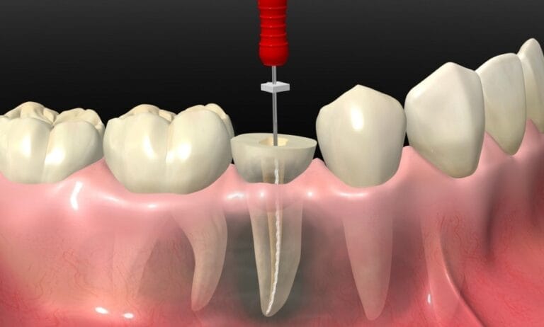 Dental crown placed after root canal treatment