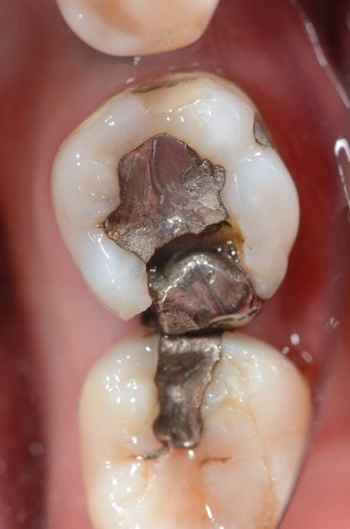 Dental crown used to strengthen worn-down teeth