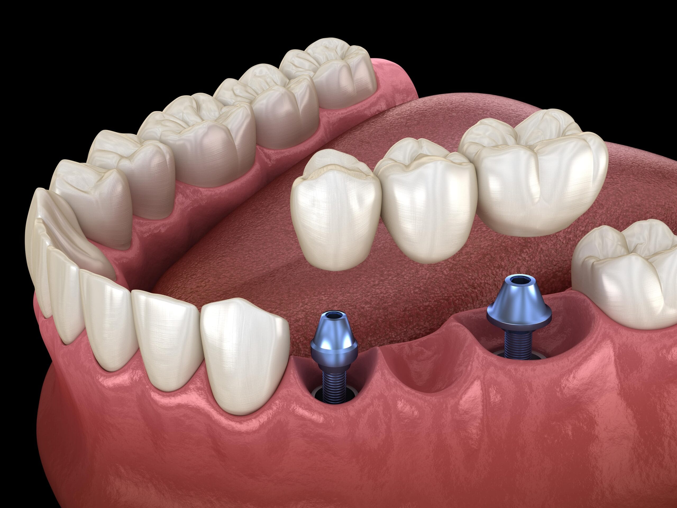 Dental crowns and bridges used to restore damaged or missing teeth