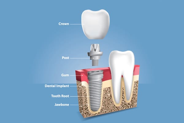 Dental implant treatment for replacing missing teeth at Smile Fusion Dental Clinic