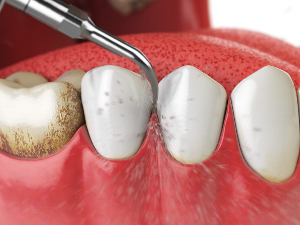 Does Scaling Loosen Teeth? 7 Facts Your Dentist Wants You to Know