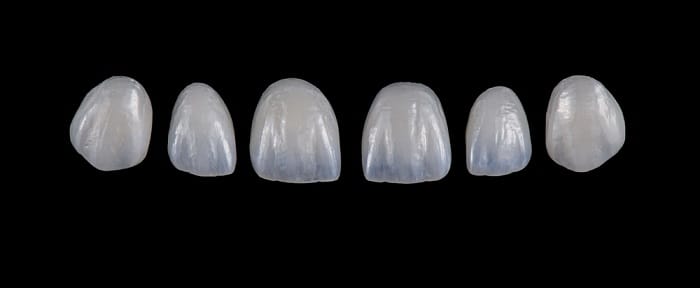 E-Max dental crown for front teeth cosmetic restoration