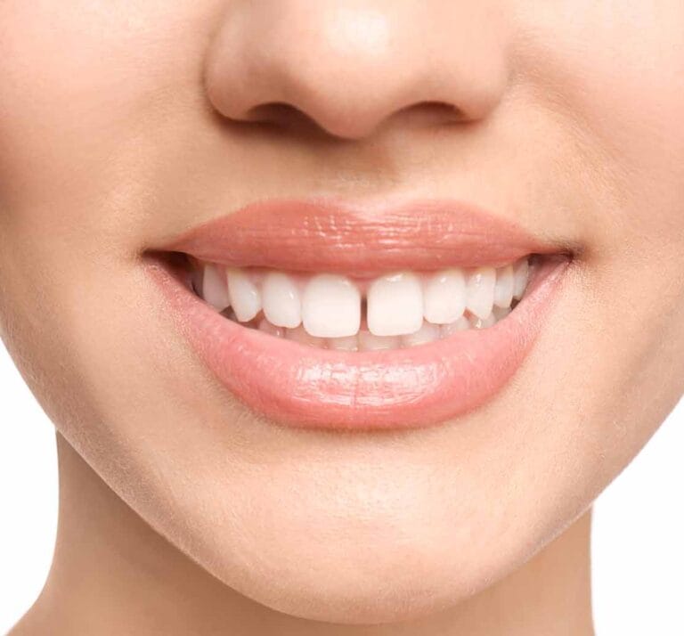 Gap between teeth correction using metal braces