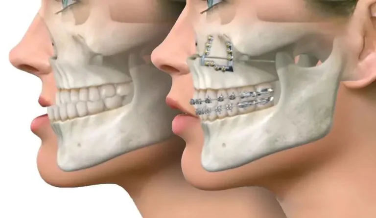 Jaw alignment correction through metal braces orthodontic treatment