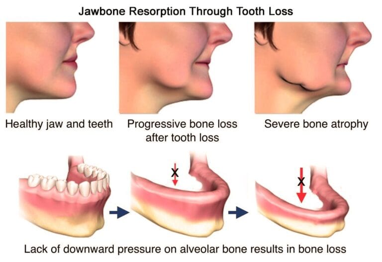 Jawbone loss prevented using dental implants