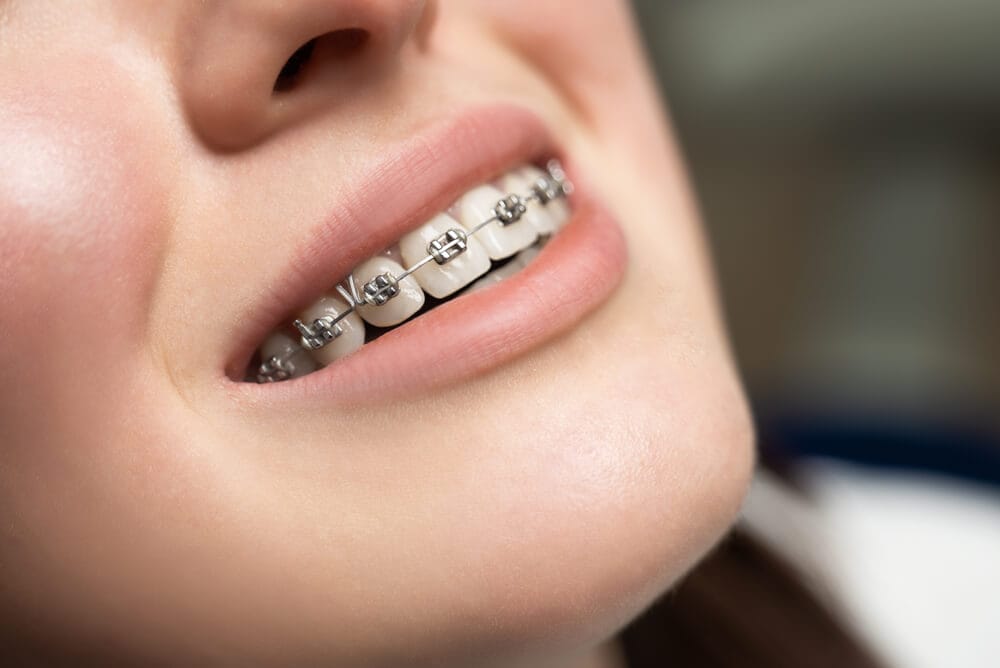 Metal Braces Orthodontic Treatment in Medavakkam