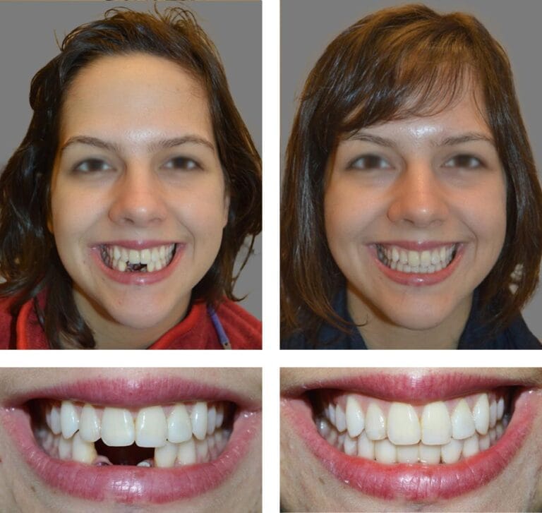 Dental implants used to replace missing teeth at Smile Fusion Dental Clinic Medavakkam