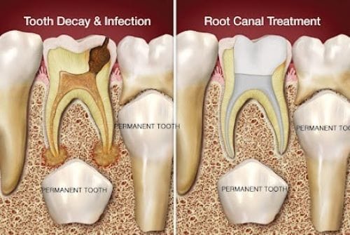 Pediatric root canal treatment for milk teeth