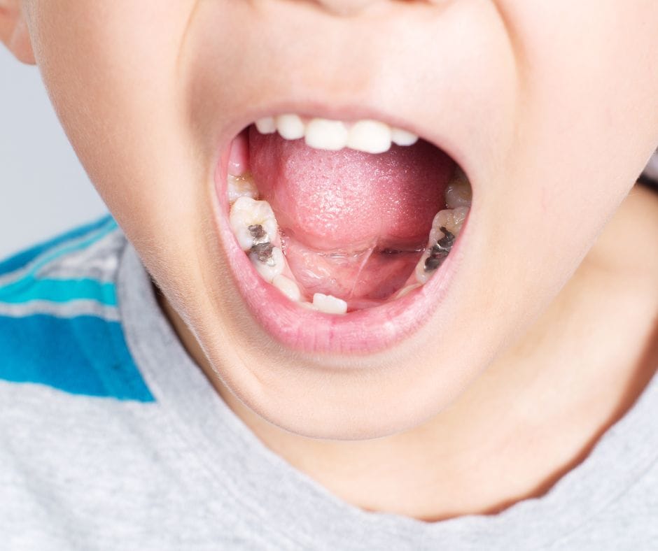 Tooth coloured fillings for children dental cavities
