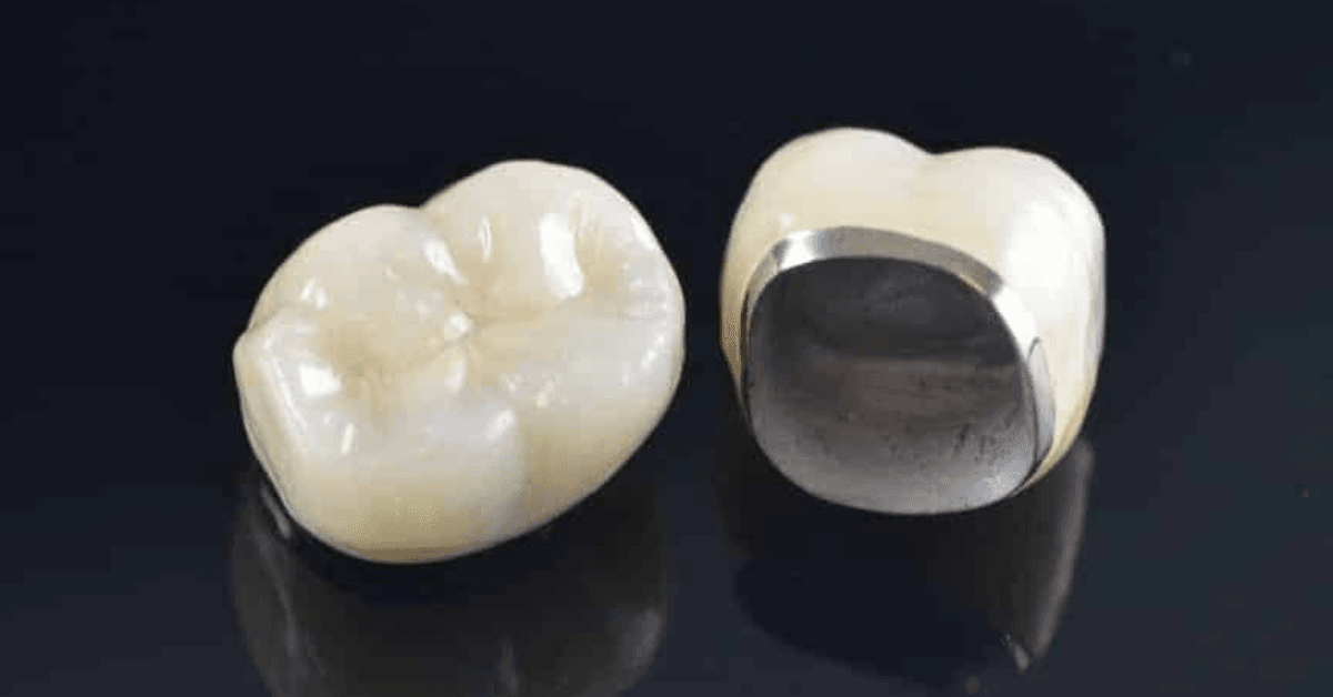 Porcelain dental crown matching natural tooth color