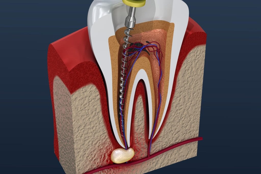 Illustration showing root canal treatment to remove tooth infection