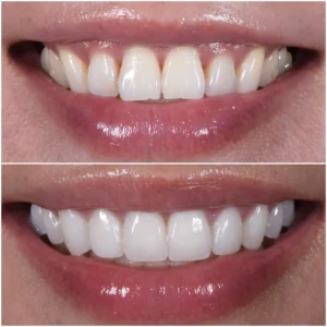 black-gums-treatment-medavakkam.jpg