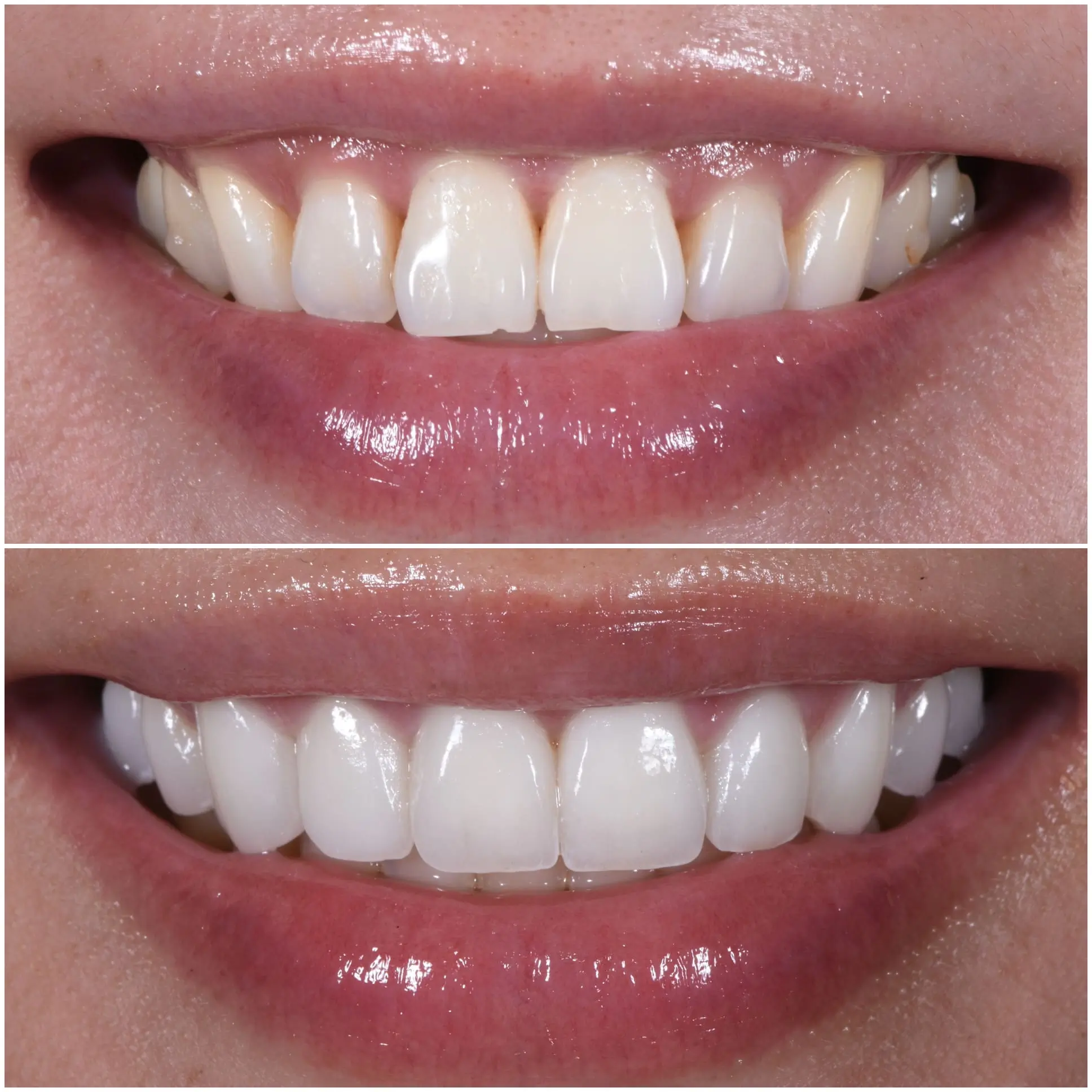 Tooth coloured fillings cosmetic dentistry treatment