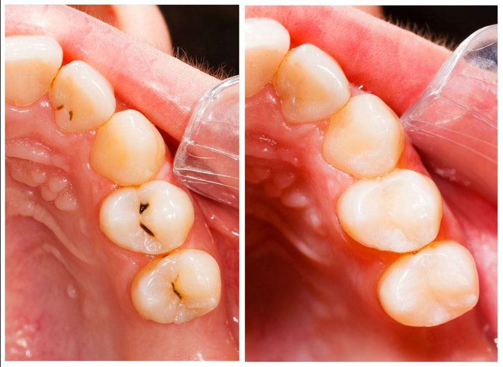 Tooth coloured dental fillings used to treat cavities naturally