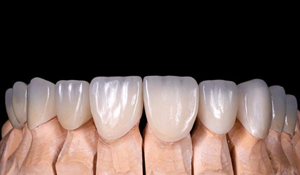 Zirconia dental crown metal-free tooth restoration
