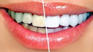 Teeth whitening treatment in Medavakkam at Smile Fusion Dental Clinic
