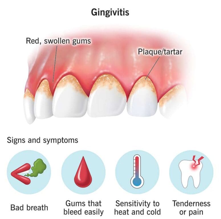 Gum bleeding treatment in Medavakkam at Smile Fusion Dental Clinic
